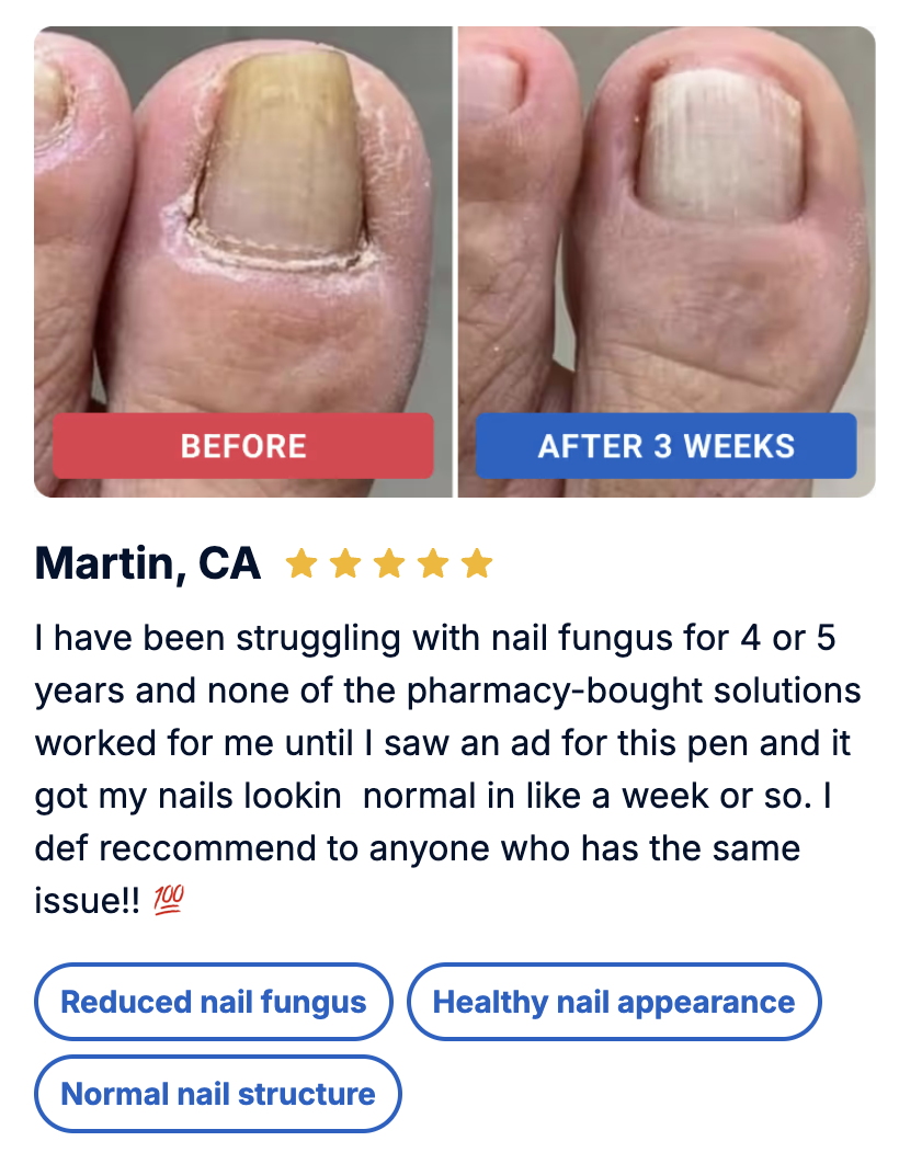 Michael's nail fungus transformation
