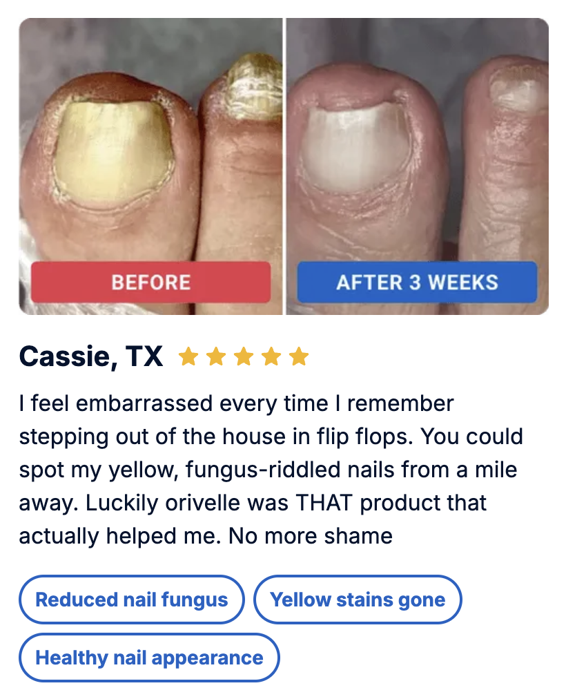 Linda's nail fungus transformation